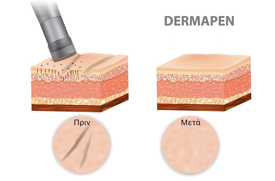 Μεσοθεραπεία με dermapen για ενυδάτωση και αντιγήρανση